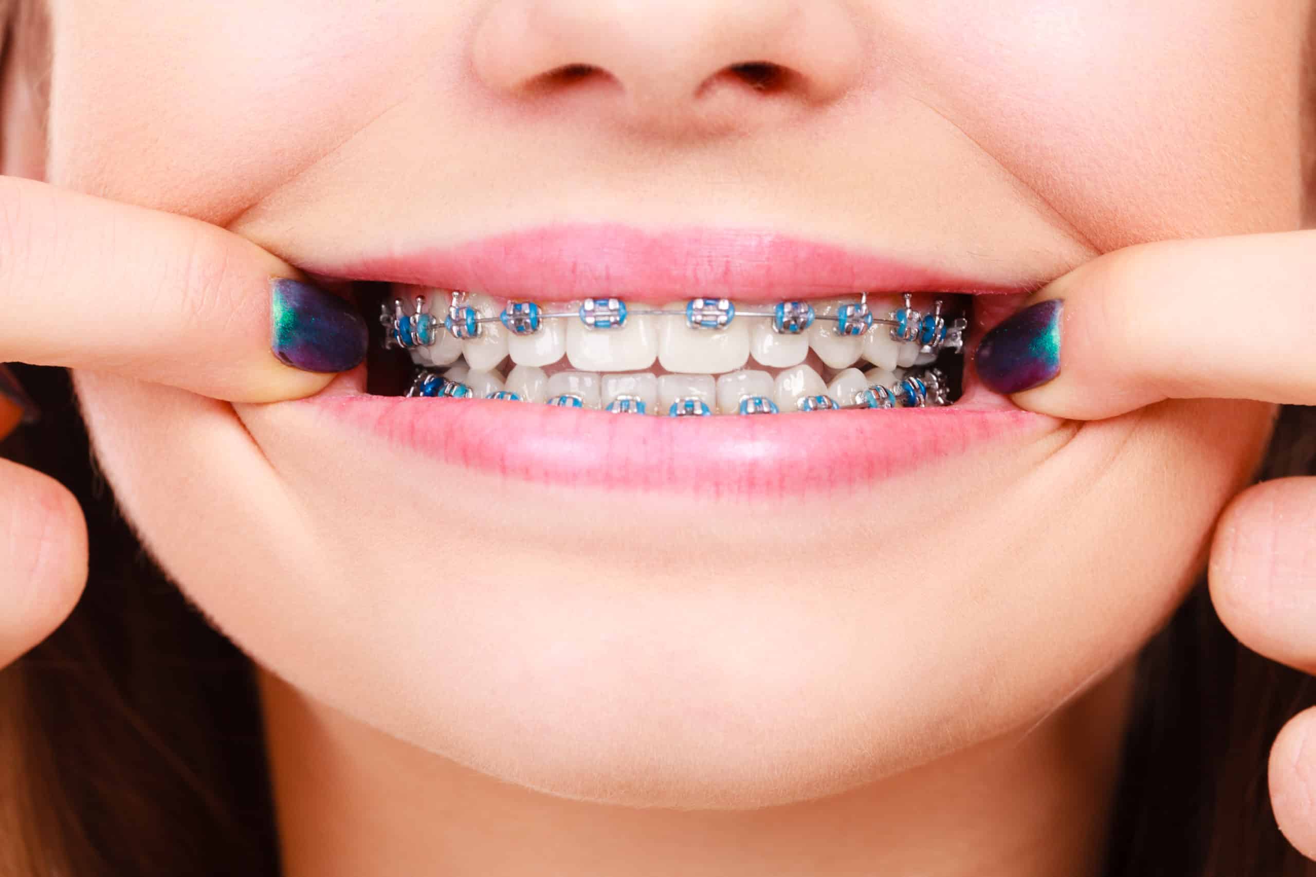 metal braces 4 scaled 1 - Revive Dental Winnipeg