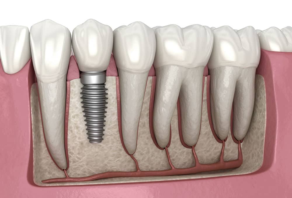 Dental implant illustration - Revive Dental Winnipeg