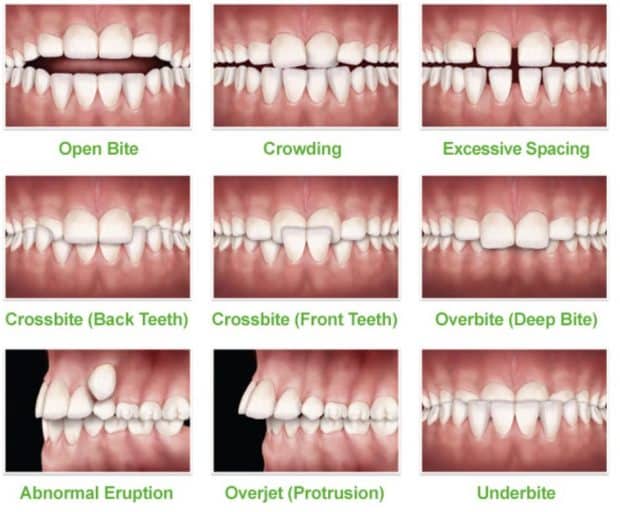 Phase 1 Orthodontic Problems 620x512 1 - Revive Dental Winnipeg