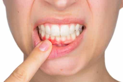 gum disease - Revive Dental Winnipeg