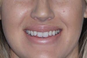 smile consult winnipeg close up - Revive Dental Winnipeg