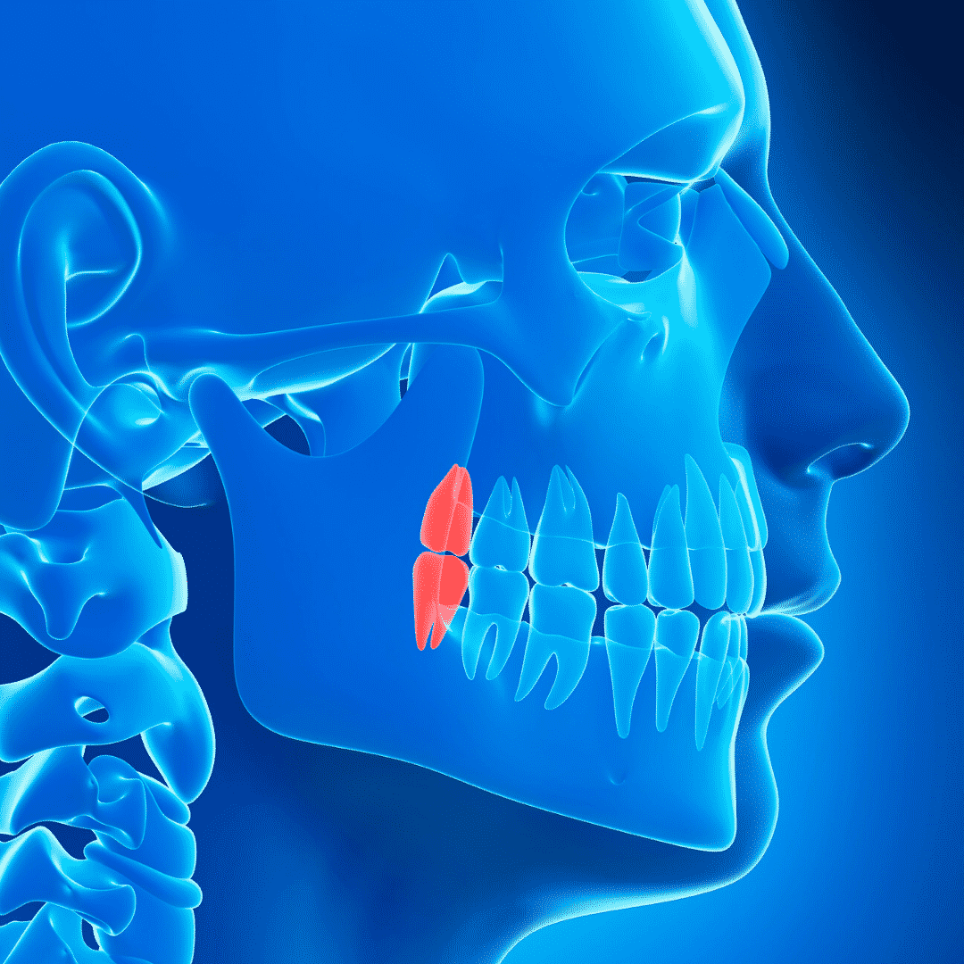 wisdom teeth scan - Revive Dental Winnipeg