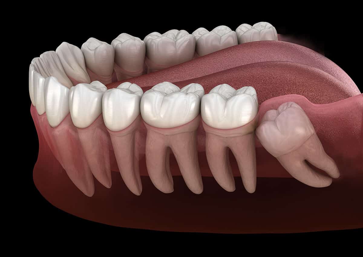 wisdom teeth - Revive Dental Winnipeg