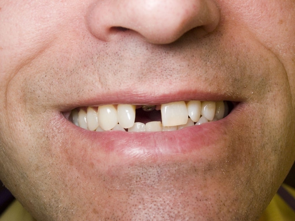 Implant website page are you missing teeth - Revive Dental Winnipeg