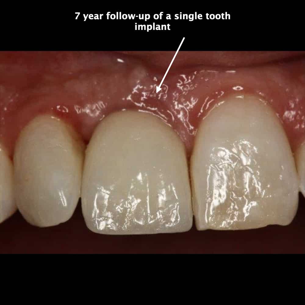 implant website page 2 - Revive Dental Winnipeg